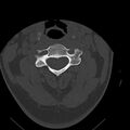 Occipital condyle fracture (Radiopaedia 31755-32691 Axial bone window 30).jpg