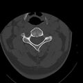Occipital condyle fracture (Radiopaedia 31755-32691 Axial bone window 32).jpg