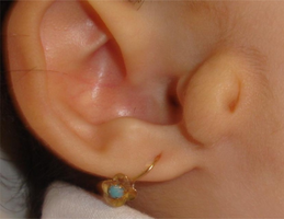 Preauricular appendices with sinus tract