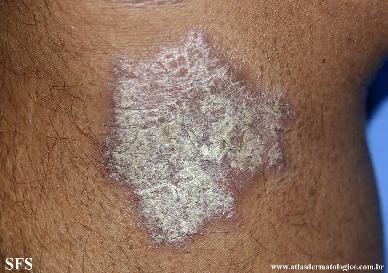File:Psoriasis (Dermatology Atlas 154).jpg