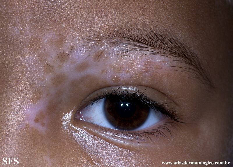 File:Vitiligo (Dermatology Atlas 47).jpg