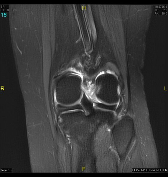 File:ACL mucoid degeration with cystic changes (Radiopaedia 48428-53341 Coronal PD fat sat 13).jpg