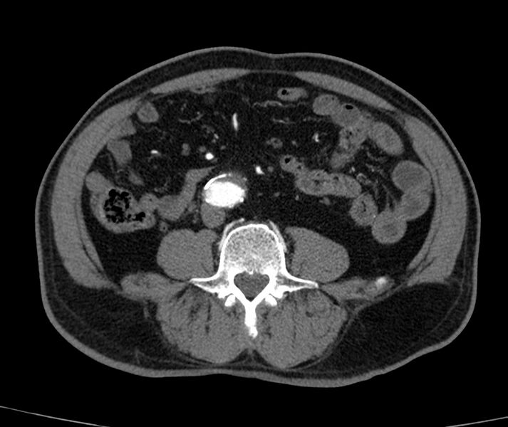 File:Abdominal aortic aneurysm (Radiopaedia 22421-22458 C+ arterial phase 55).jpg