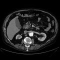 Abdominal aortic aneurysm (Radiopaedia 25855-26001 Axial C+ arterial phase 52).jpg
