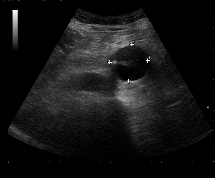 File:Abdominal aortic aneurysm (Radiopaedia 34563-35938 C 1).jpg