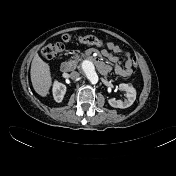File:Abdominal aortic aneurysm (Radiopaedia 75131-86203 Axial C+ arterial phase 19).jpg
