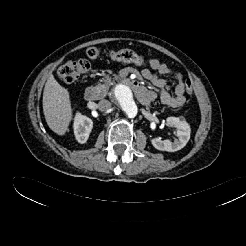 Abdominal aortic aneurysm (Radiopaedia 75131-86203 Axial C+ arterial phase 19).jpg