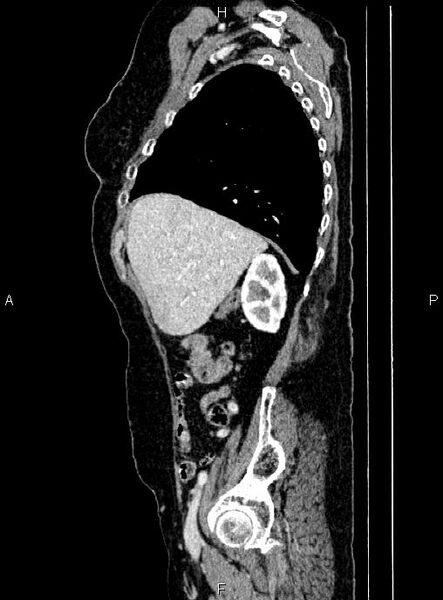 File:Abdominal aortic aneurysm (Radiopaedia 85063-100606 Sagittal C+ arterial phase 18).jpg