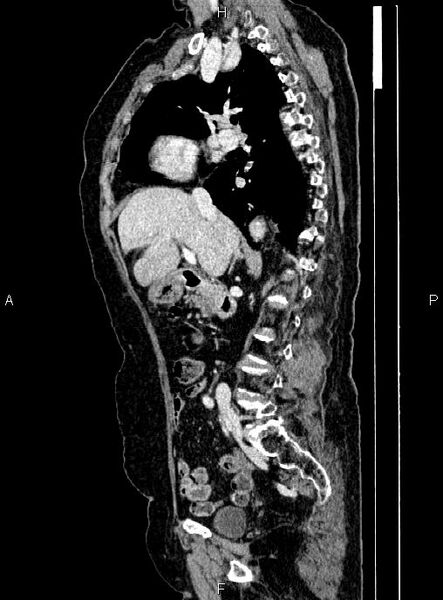 File:Abdominal aortic aneurysm (Radiopaedia 85063-100606 Sagittal C+ arterial phase 31).jpg