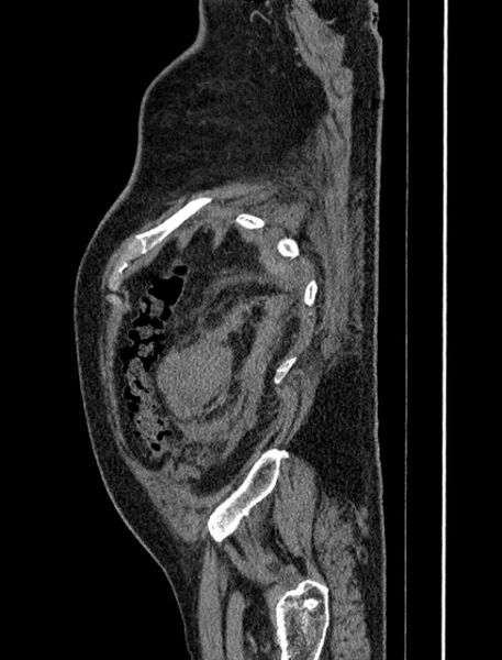File:Abdominal aortic aneurysm rupture (Radiopaedia 54179-60362 Sagittal C+ arterial phase 42).jpg