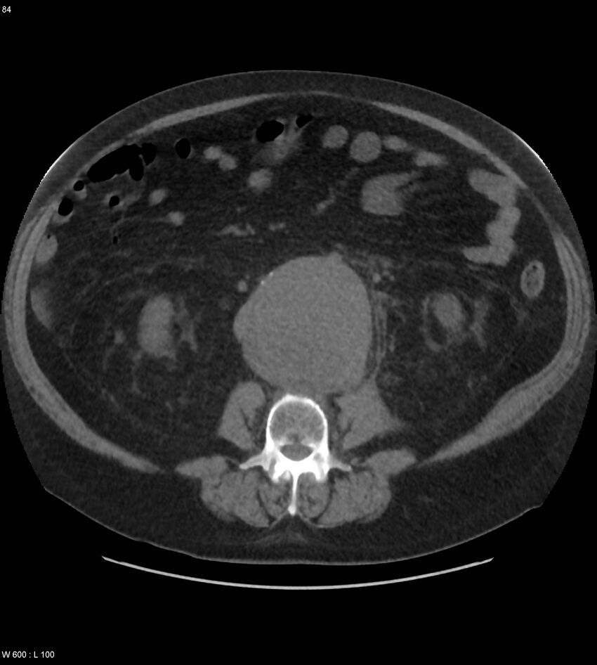 Abdominal aortic aneurysm with intramural hematoma then rupture (Radiopaedia 50278-55631 Axial non-contrast 80).jpg