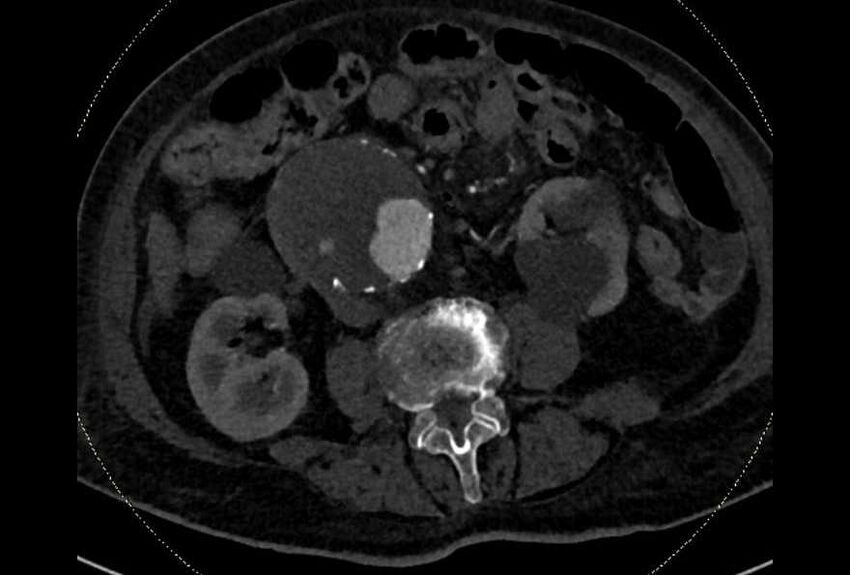 Abdominal aortic aneurysm with thrombus fissuration (Radiopaedia 73192-83919 Axial C+ arterial phase 107).jpg