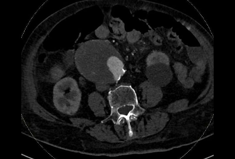 File:Abdominal aortic aneurysm with thrombus fissuration (Radiopaedia 73192-83919 Axial C+ arterial phase 122).jpg