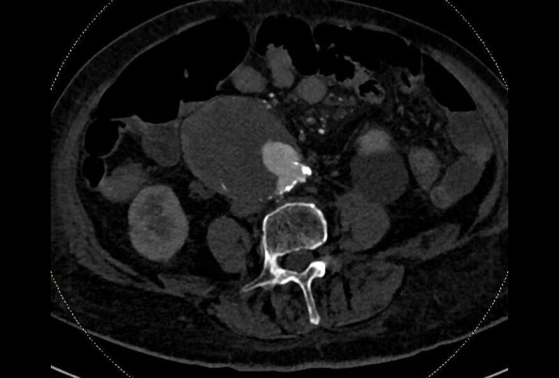 File:Abdominal aortic aneurysm with thrombus fissuration (Radiopaedia 73192-83919 Axial C+ arterial phase 127).jpg