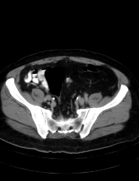 File:Abdominal lymphoma - with sandwich sign (Radiopaedia 53486-59492 Axial C+ portal venous phase 39).jpg