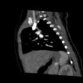 Aberrant left pulmonary artery (pulmonary sling) (Radiopaedia 42323-45435 Sagittal C+ arterial phase 37).jpg