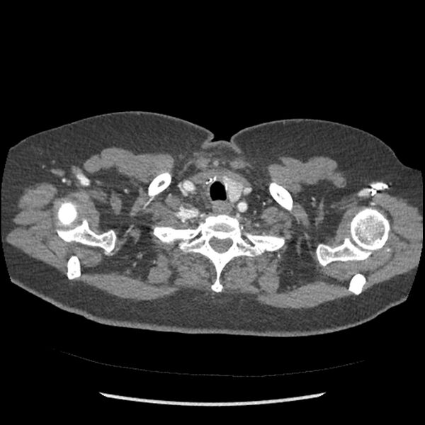 File:Aberrant right subclavian and left vertebral arteries (Radiopaedia 43467-46847 Axial C+ portal venous phase 7).jpg