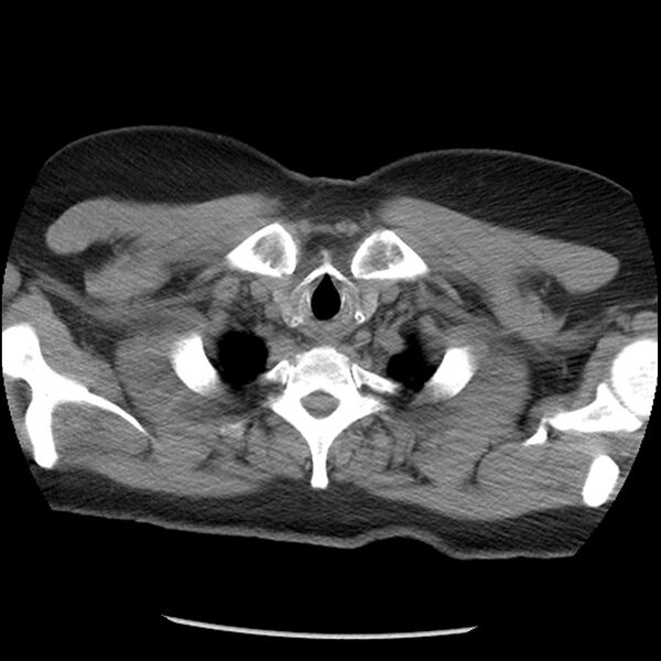 File:Aberrant right subclavian artery (Radiopaedia 40967-43680 Axial non-contrast 3).jpg