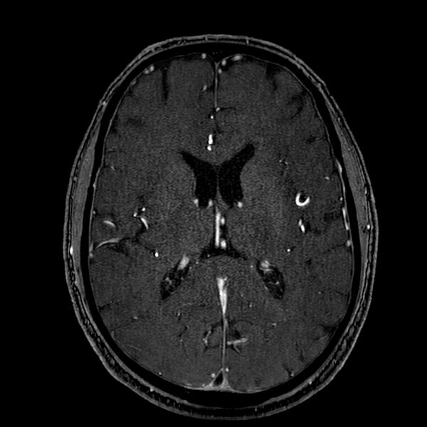 File:Accessory middle cerebral artery (Radiopaedia 73114-83828 Axial MRA 119).jpg
