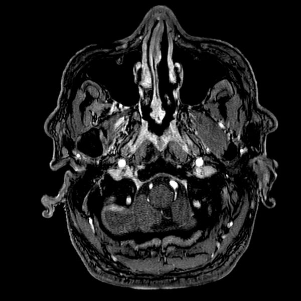 File:Accessory middle cerebral artery (Radiopaedia 73114-83828 Axial MRA 6).jpg