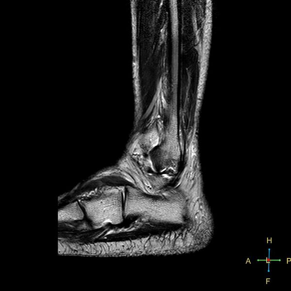 File:Achilles tendon complete tear (Radiopaedia 22834-22854 Sagittal T2 3).jpg