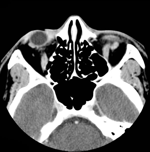 File:Acinic cell carcinoma of the lacrimal gland (Radiopaedia 9480-10160 Axial C+ arterial phase 2).jpg