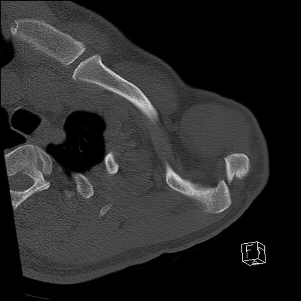 File:Acromioclavicular joint dissociation - type IV (Radiopaedia 64411-73216 Axial bone window 10).jpg