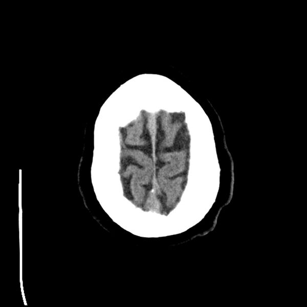 File:Acute A3 occlusion with ACA ischemic penumbra (CT perfusion) (Radiopaedia 72036-82525 Axial non-contrast 43).jpg