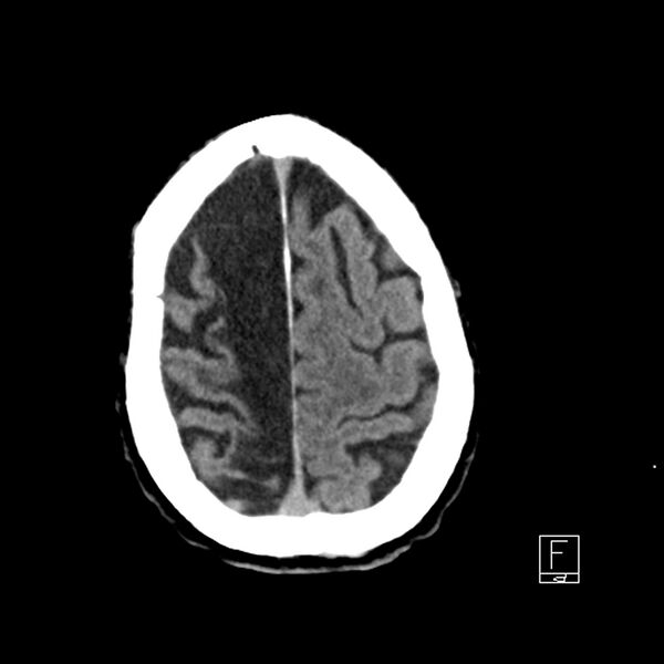 File:Acute ICA ischemic penumbra due to high-grade CCA stenosis (CT perfusion) (Radiopaedia 72038-82529 Axial non-contrast 40).jpg