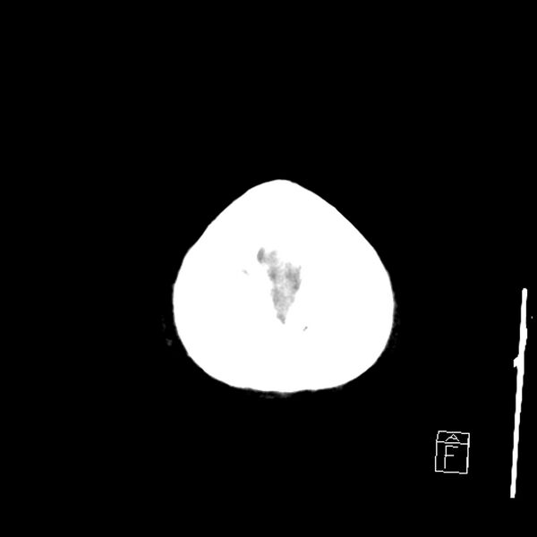 File:Acute P1 occlusion with PCA ischemia penumbra (CT perfusion) (Radiopaedia 72084-82586 Axial non-contrast 46).jpg