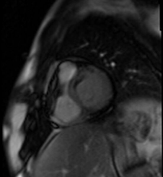 File:Acute anteroseptal myocardial infarction (Radiopaedia 68409-77945 Short axis (basal) Perfusion 20).jpg