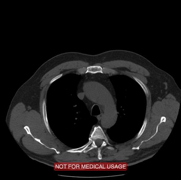 File:Acute aortic dissection - Stanford type A (Radiopaedia 40661-43285 Axial non-contrast 6).jpg