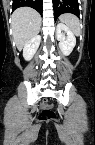 File:Acute appendicitis (Radiopaedia 22892-22918 Coronal C+ portal venous phase 43).png