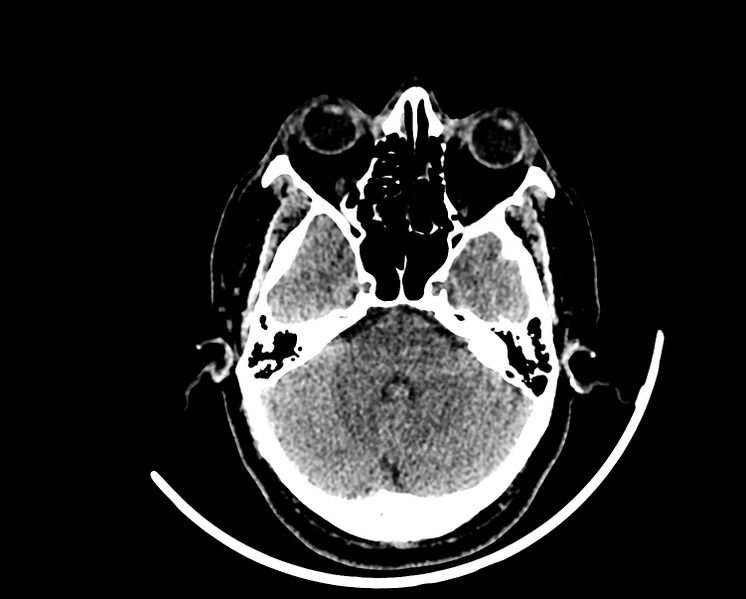 File:Acute cerebral infarct (Radiopaedia 35604-37123 Axial non-contrast 25).jpg
