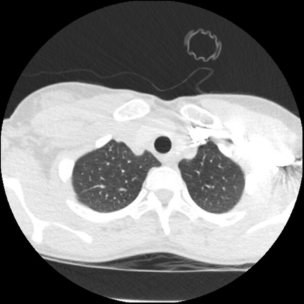 File:Acute chest syndrome - sickle cell disease (Radiopaedia 42375-45499 Axial lung window 31).jpg