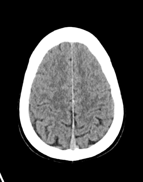 File:Acute disseminated encephalomyelitis (ADEM) (Radiopaedia 65319-74348 Axial non-contrast 26).png