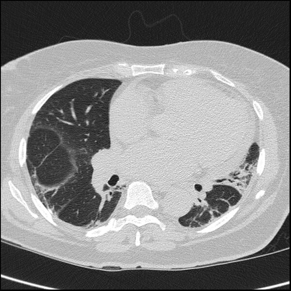 File:Acute interstitial pneumonitis (Radiopaedia 45404-49453 Axial lung window 48).jpg
