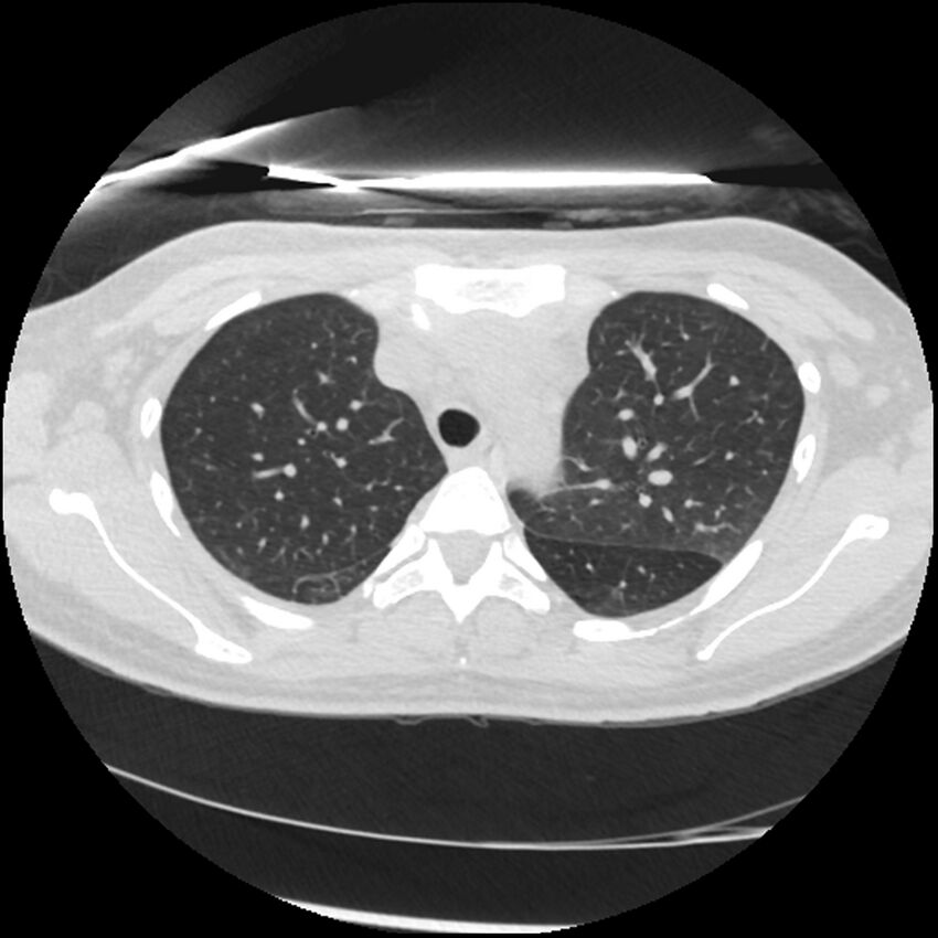 Acute lupus nephritis (Radiopaedia 45832-50107 Axial lung window 22).jpg