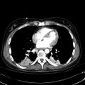 Acute myocardial infarction in CT (Radiopaedia 39947-42415 Axial C+ arterial phase 87).jpg