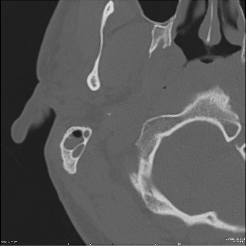 Acute otomastoiditis (Radiopaedia 28276-28512 Axial PTB bone window reformat 73).jpg