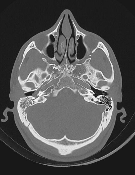 File:Acute otomastoiditis (Radiopaedia 28329-28575 Axial bone window 4).jpg