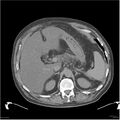 Acute pancreatitis (Radiopaedia 19135-19116 Axial non-contrast 9).jpg