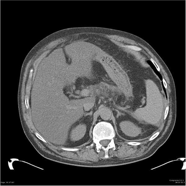 File:Acute pancreatitis (Radiopaedia 19135-19116 Axial non-contrast 9).jpg