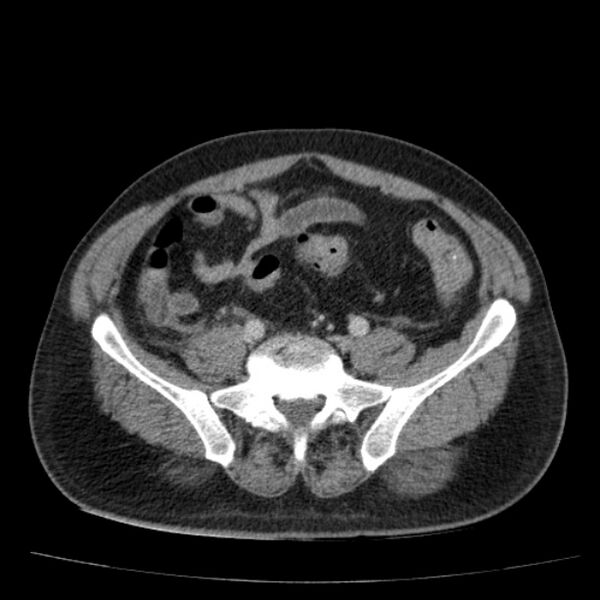 File:Acute pancreatitis (Radiopaedia 26663-26813 Axial C+ portal venous phase 63).jpg