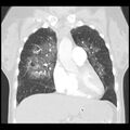 Acute pulmonary edema on CT (Radiopaedia 33582-34672 Coronal lung window 12).jpg