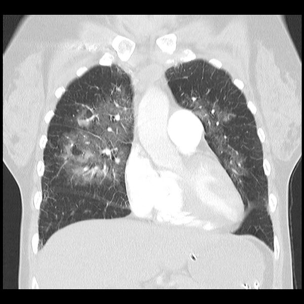 File:Acute pulmonary edema on CT (Radiopaedia 33582-34672 Coronal lung window 12).jpg