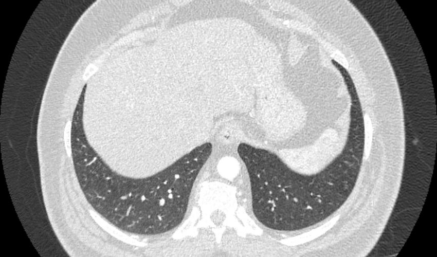 Acute pulmonary embolism with pulmonary infarcts (Radiopaedia 77688-89908 Axial lung window 110).jpg