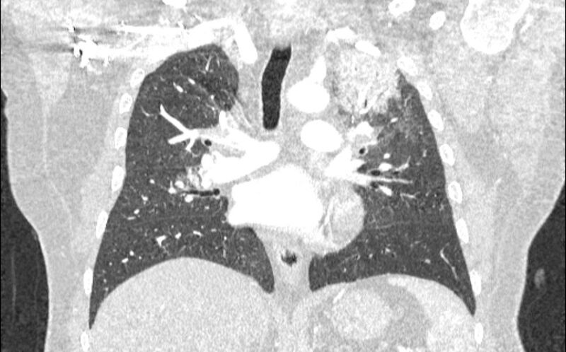 File:Acute pulmonary embolism with pulmonary infarcts (Radiopaedia 77688-89908 Coronal lung window 50).jpg
