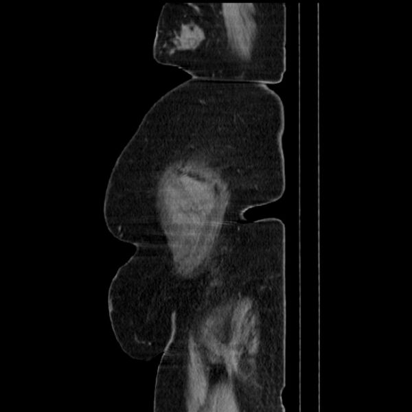 File:Acute pyelonephritis (Radiopaedia 25657-25837 Sagittal renal parenchymal phase 74).jpg