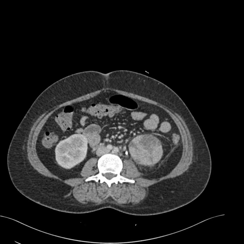 Acute pyelonephritis with renal vein thrombosis (Radiopaedia 58020-65053 Axial renal parenchymal phase 109).jpg